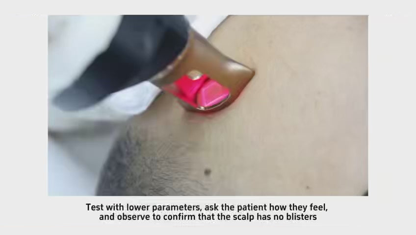 treatment for hair treatment loss frax
